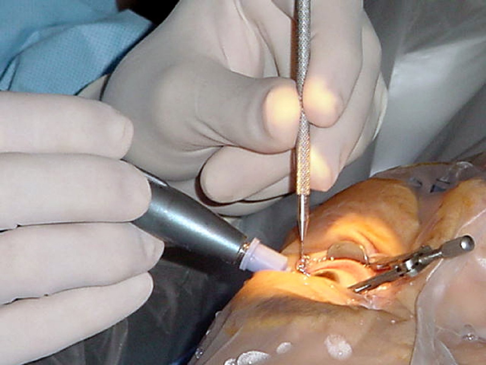 Vision Treatment